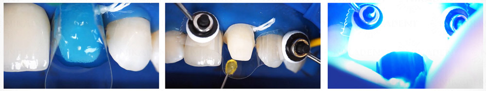 Variolink Esthetic LC, инструкция по применению Variolink Esthetic LC, инструкция по применению