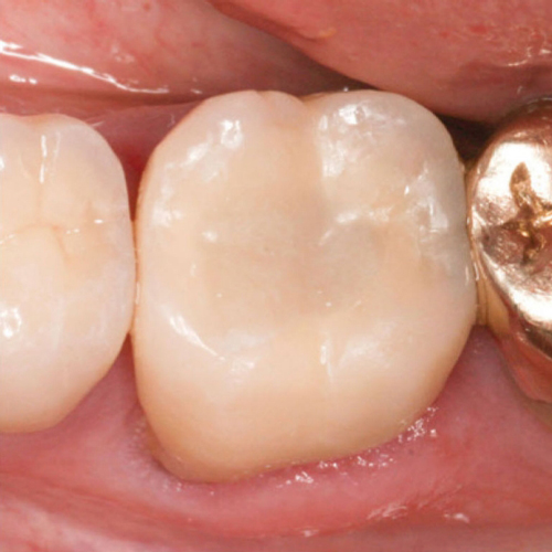 SDR Dentsply SDR Dentsply
