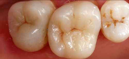 ceram.x SphereTEC Dentsply ceram.x SphereTEC Dentsply