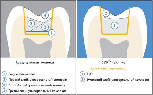 SDR Dentsply SDR Dentsply