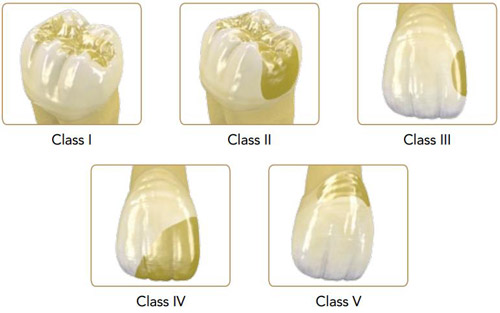 G-aenial Universal Flo – подходит для всех полостей G-aenial Universal Flo – подходит для всех полостей