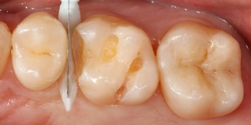 ceram.x SphereTEC Dentsply ceram.x SphereTEC Dentsply