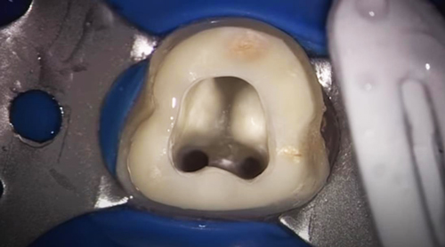 Обтураторы Thermafil Dentsply Обтураторы Thermafil Dentsply